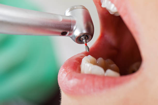 Best Emergency Dental Care for Broken or Chipped Teeth in Marin City, CA
